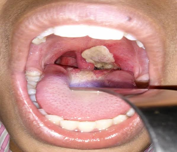 Diphtheria outbreak worsens, kills 27 in Plateau